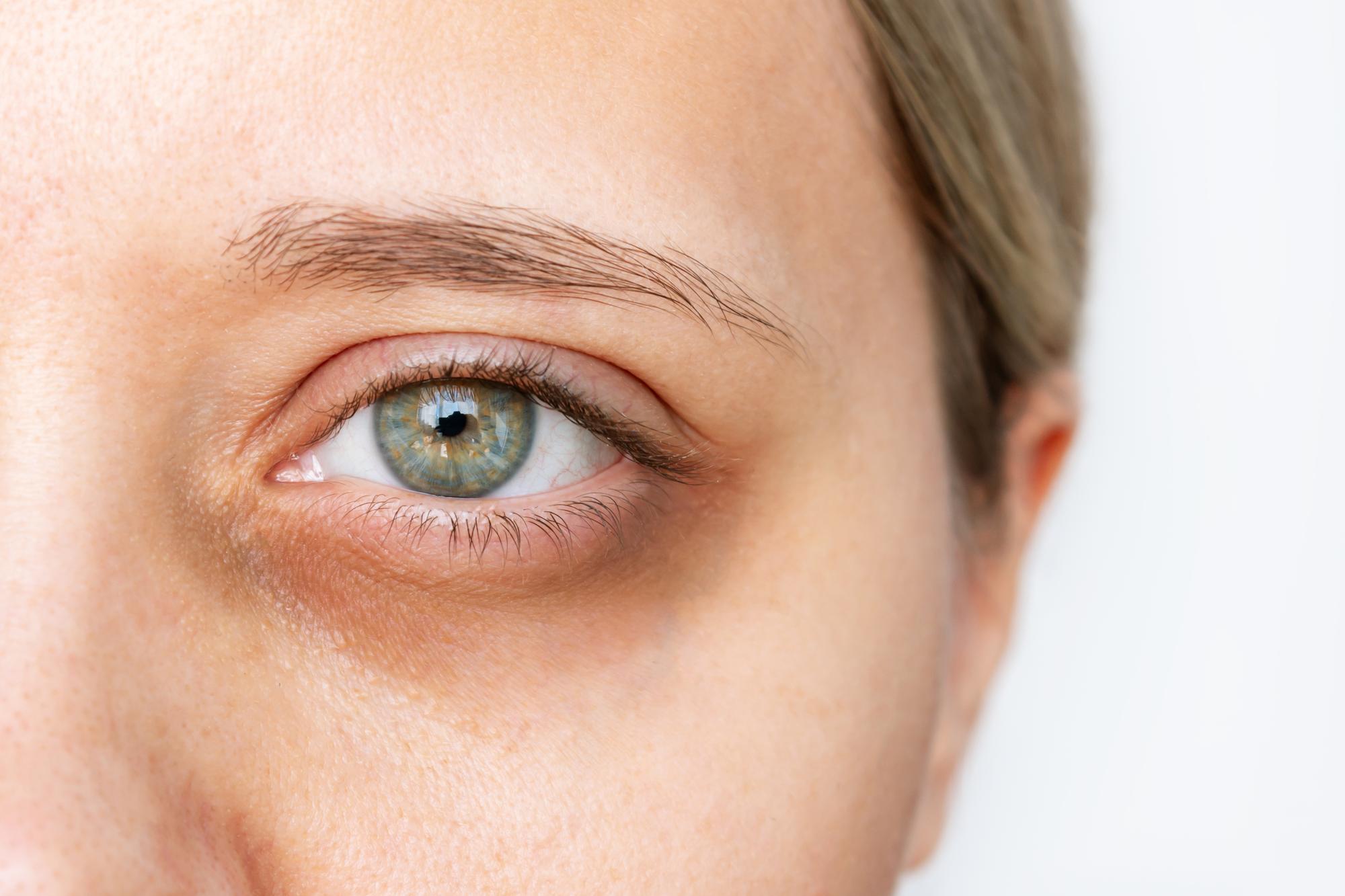 Dark Circles Under Your Eyes